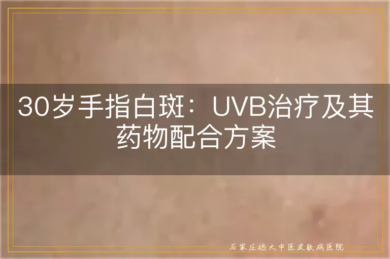 30岁手指白斑：UVB治疗及其药物配合方案
