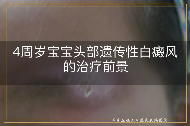 4周岁宝宝头部遗传性白癜风的治疗前景