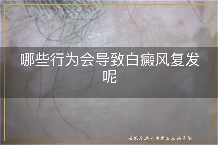 哪些行为会导致白癜风复发呢