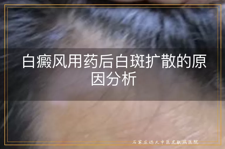 白癜风用药后白斑扩散的原因分析