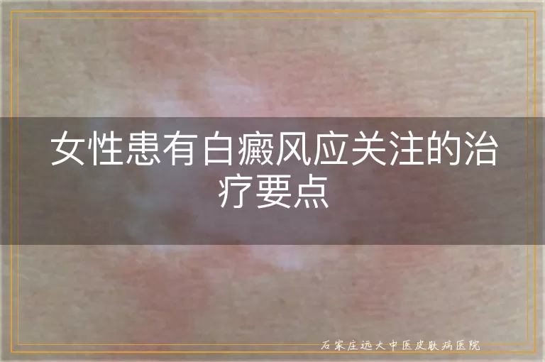 女性患有白癜风应关注的治疗要点