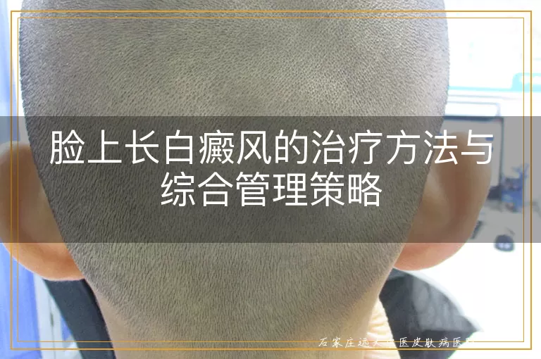 脸上长白癜风的治疗方法与综合管理策略