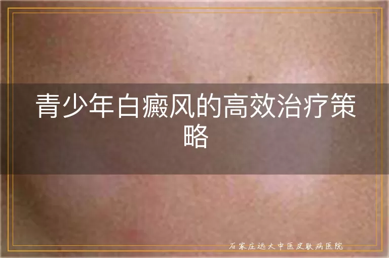 青少年白癜风的高效治疗策略