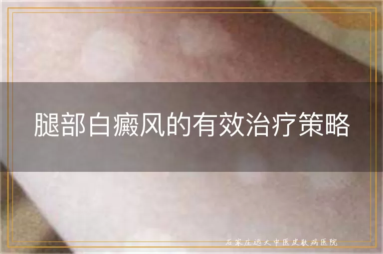 腿部白癜风的有效治疗策略