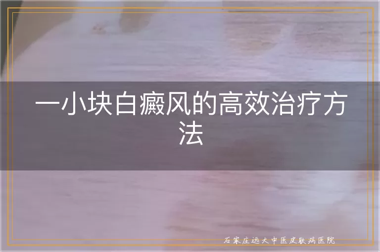 一小块白癜风的高效治疗方法