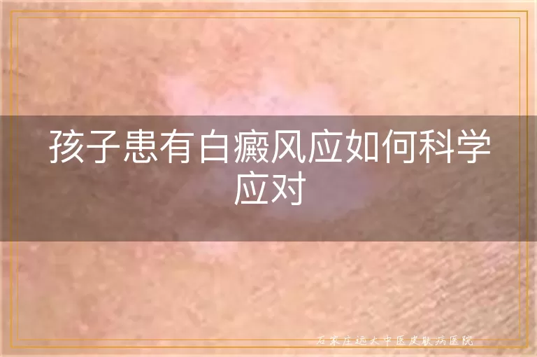 孩子患有白癜风应如何科学应对