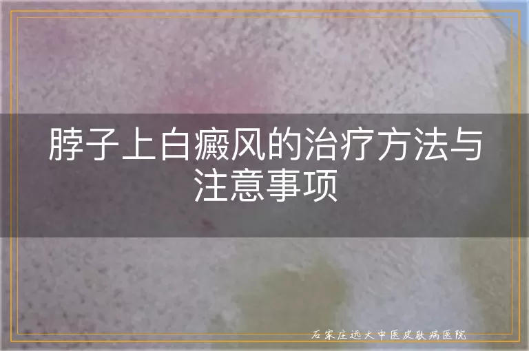 脖子上白癜风的治疗方法与注意事项