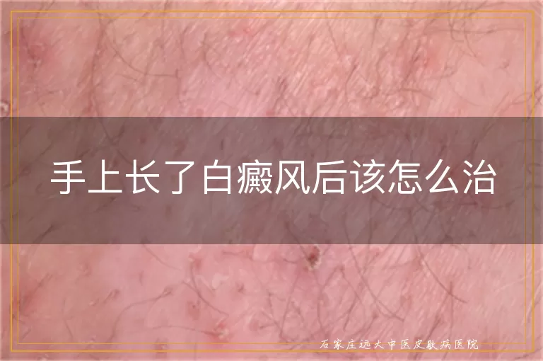 手上长了白癜风后该怎么治