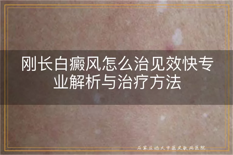 刚长白癜风怎么治见效快专业解析与治疗方法