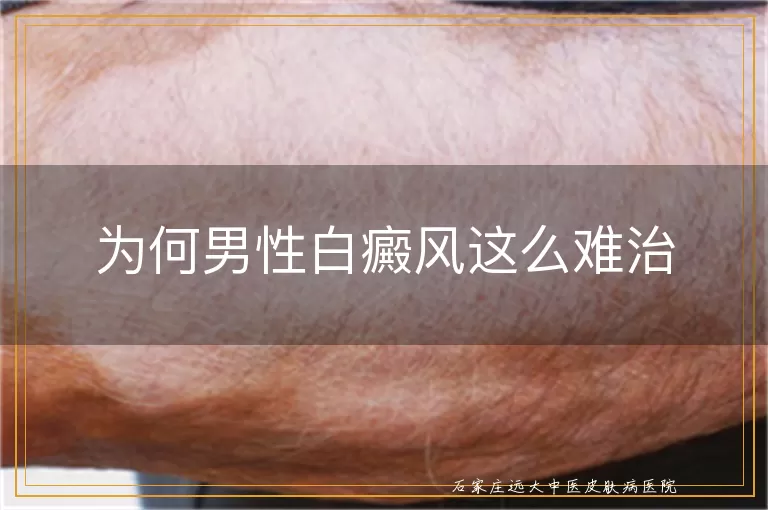 为何男性白癜风这么难治