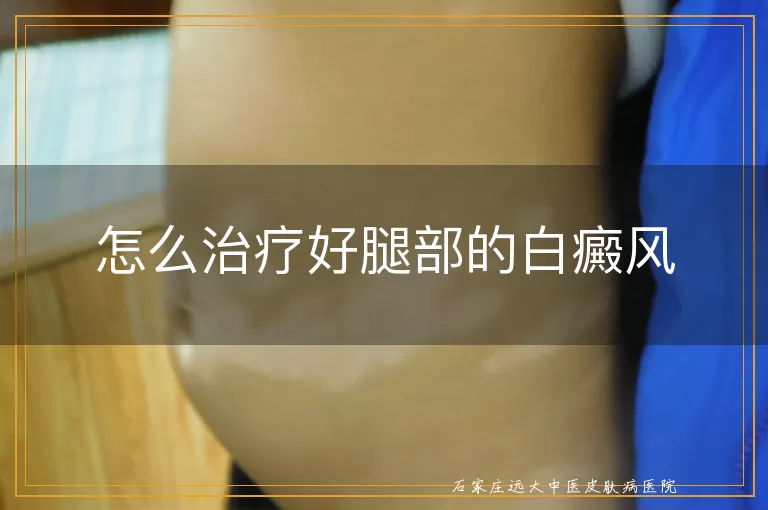 怎么治疗好腿部的白癜风