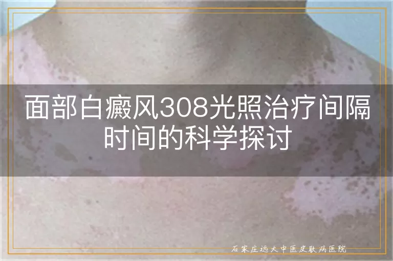 面部白癜风308光照治疗间隔时间的科学探讨