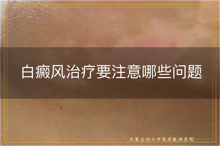 白癜风治疗要注意哪些问题