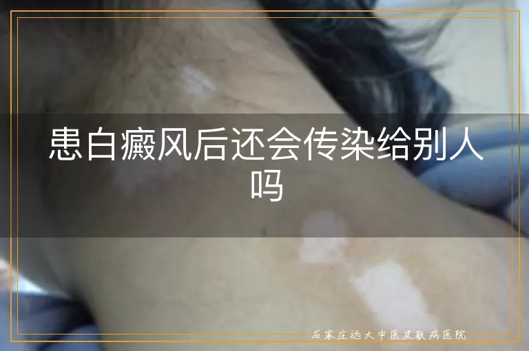 患白癜风后还会传染给别人吗