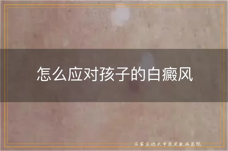 怎么应对孩子的白癜风