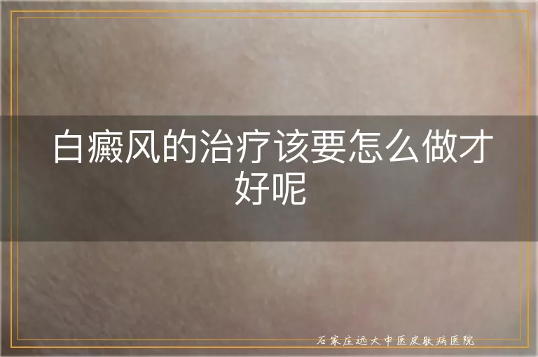 白癜风的治疗该要怎么做才好呢