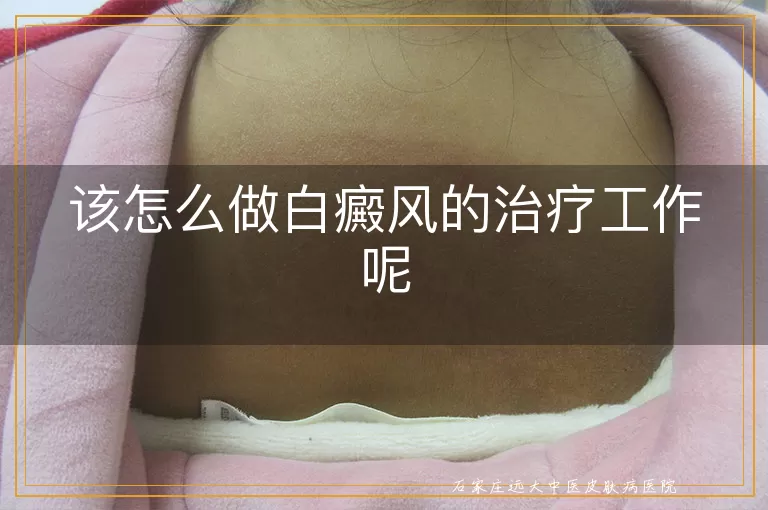 该怎么做白癜风的治疗工作呢