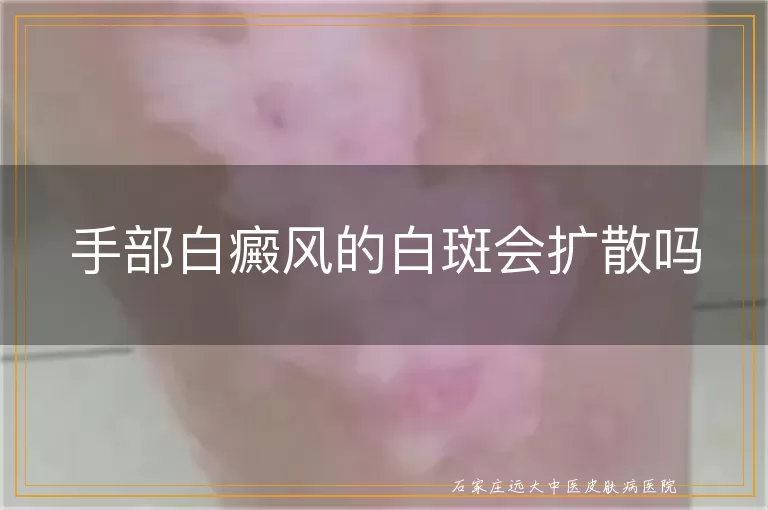 手部白癜风的白斑会扩散吗