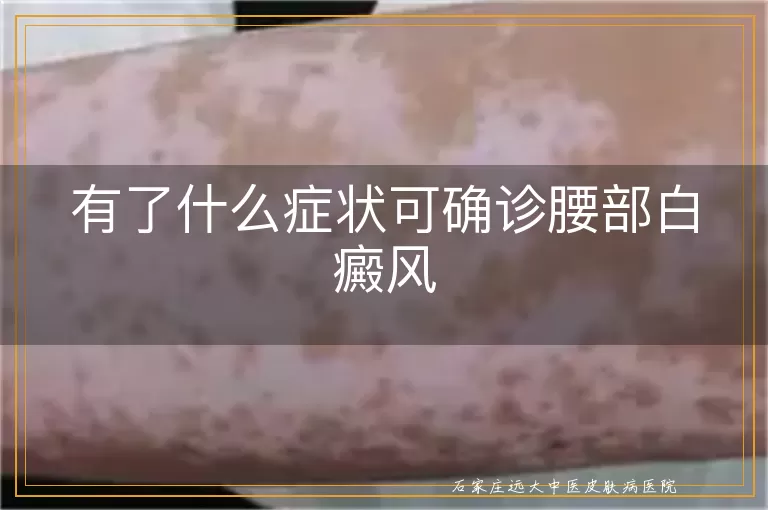 有了什么症状可确诊腰部白癜风