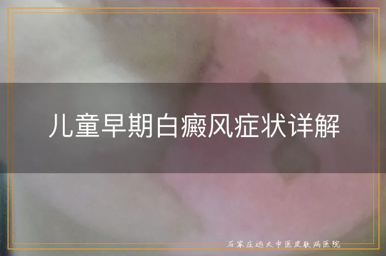 儿童早期白癜风症状详解
