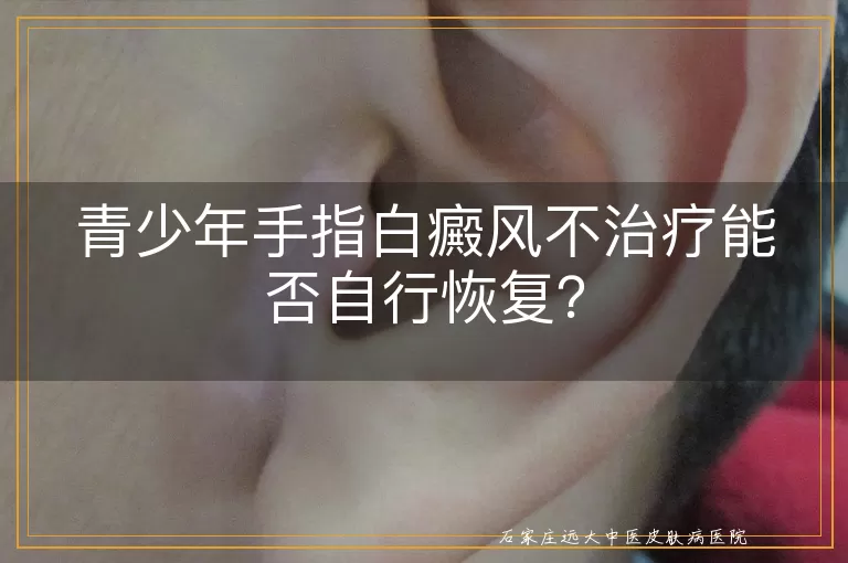 青少年手指白癜风不治疗能否自行恢复？