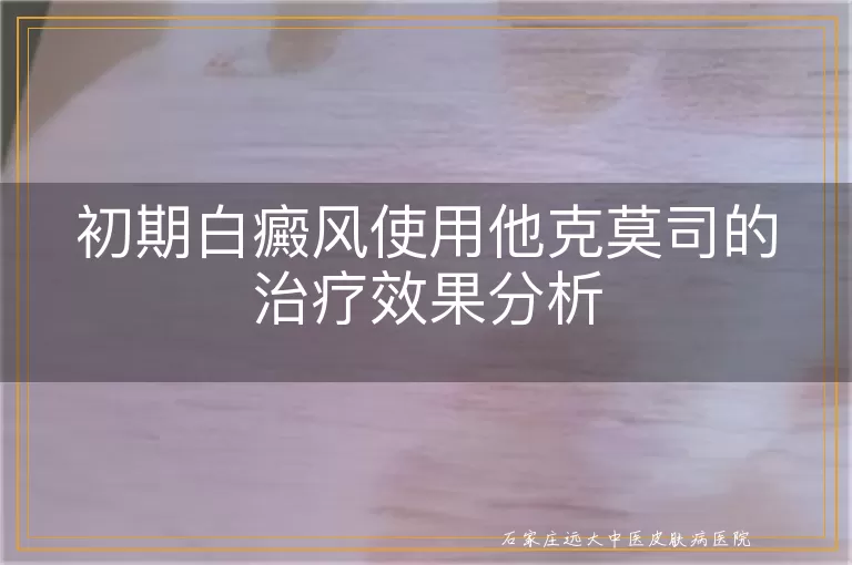 初期白癜风使用他克莫司的治疗效果分析