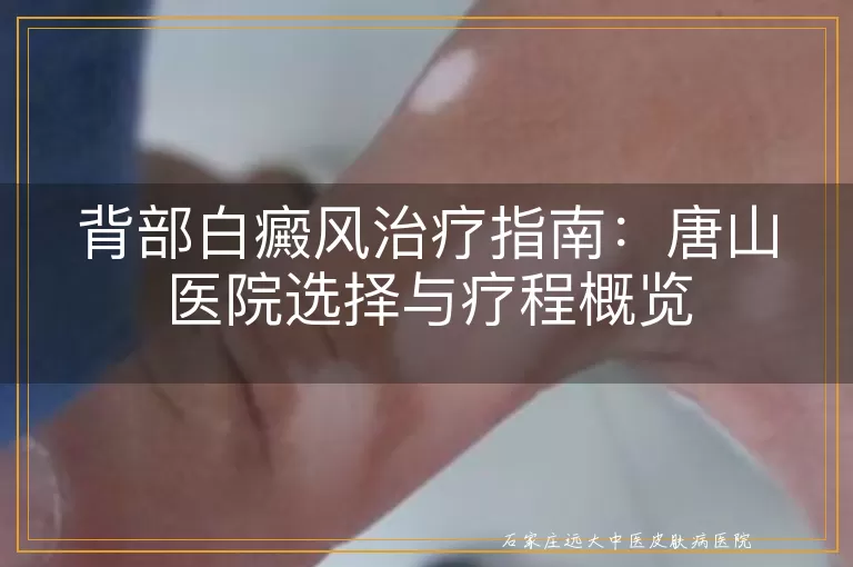背部白癜风治疗指南：唐山医院选择与疗程概览