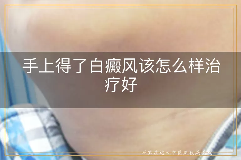 手上得了白癜风该怎么样治疗好