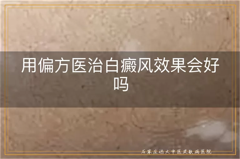 用偏方医治白癜风效果会好吗
