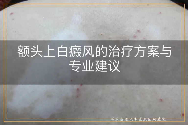 额头上白癜风的治疗方案与专业建议