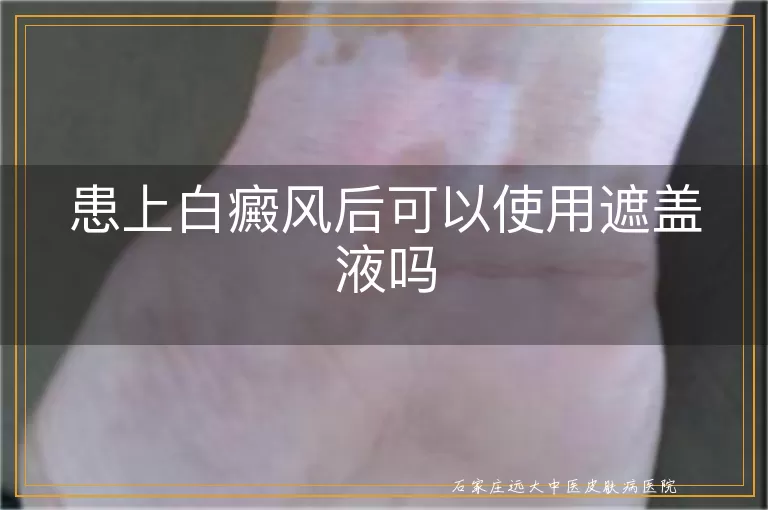 患上白癜风后可以使用遮盖液吗