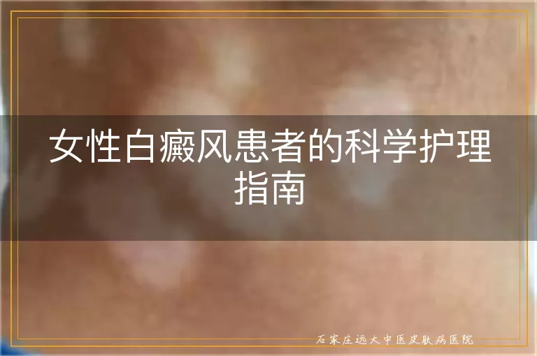 女性白癜风患者的科学护理指南