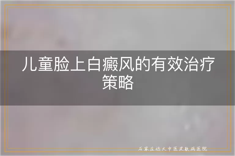 儿童脸上白癜风的有效治疗策略