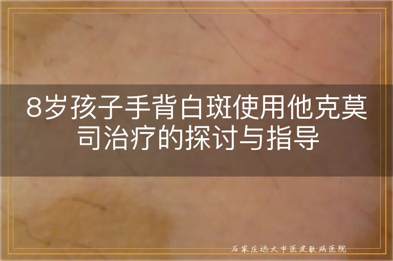 8岁孩子手背白斑使用他克莫司治疗的探讨与指导