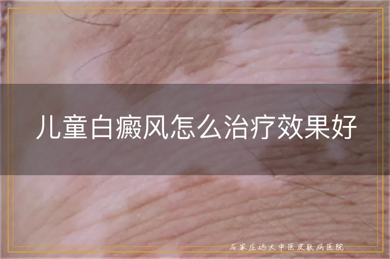 儿童白癜风怎么治疗效果好