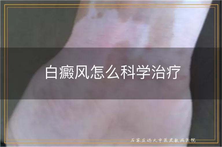 白癜风怎么科学治疗