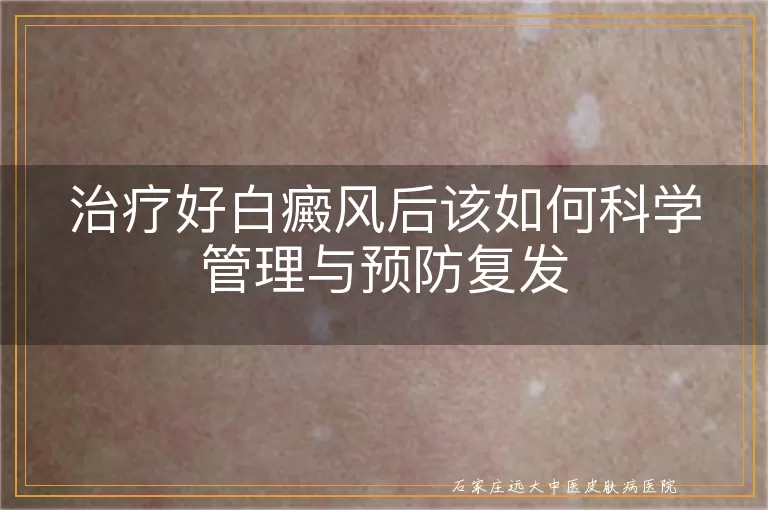 治疗好白癜风后该如何科学管理与预防复发