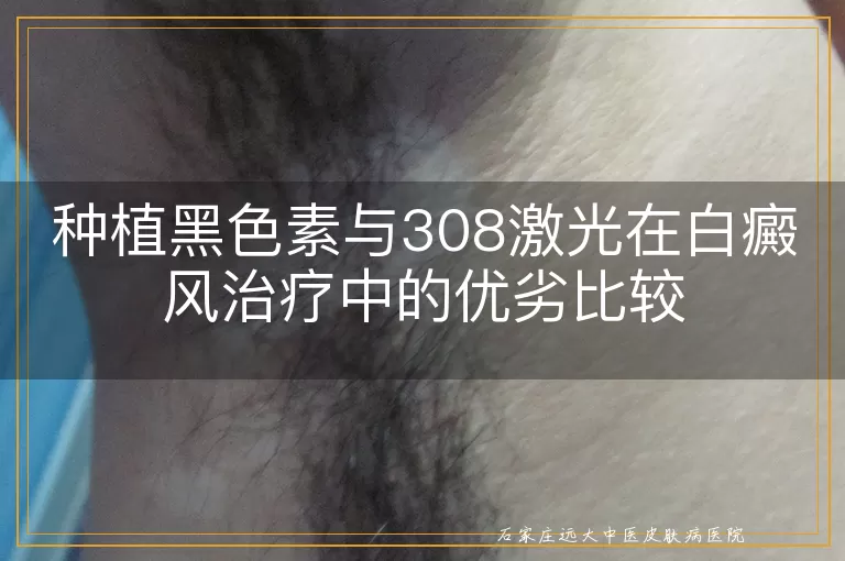 种植黑色素与308激光在白癜风治疗中的优劣比较