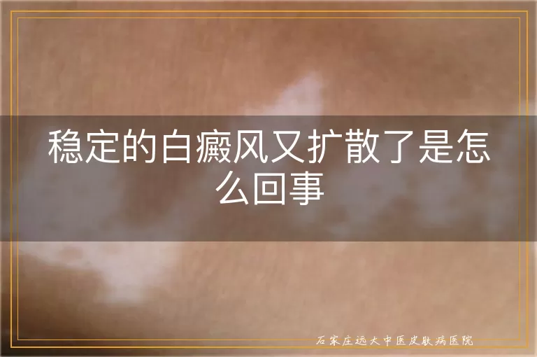 稳定的白癜风又扩散了是怎么回事