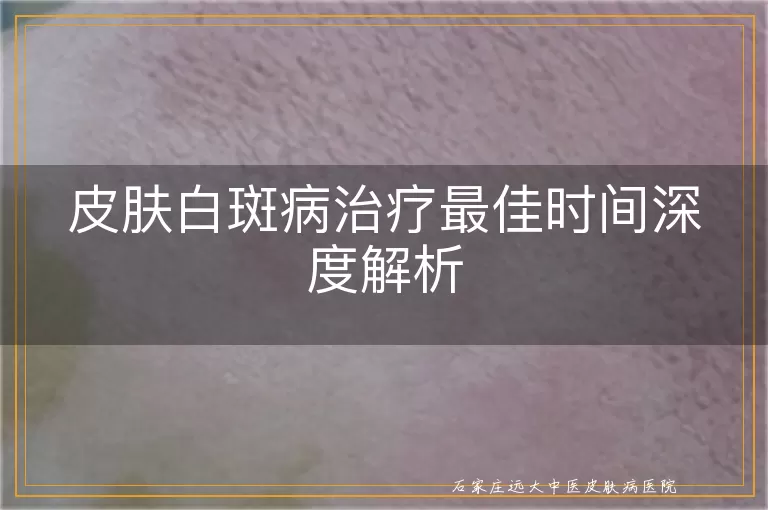 皮肤白斑病治疗最佳时间深度解析