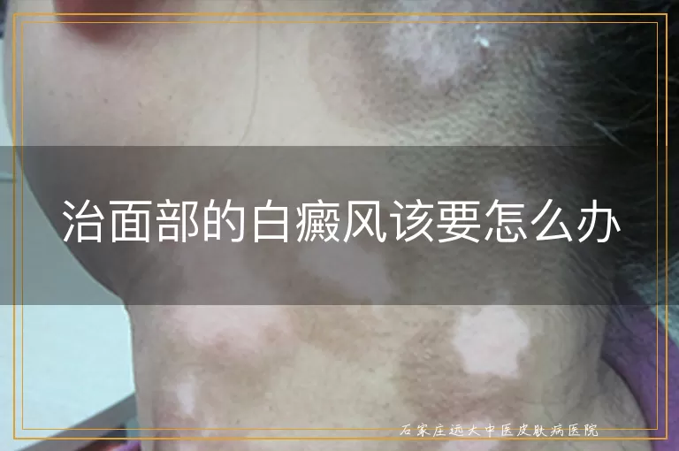 治面部的白癜风该要怎么办