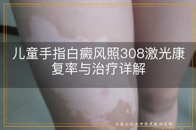 儿童手指白癜风照308激光康复率与治疗详解