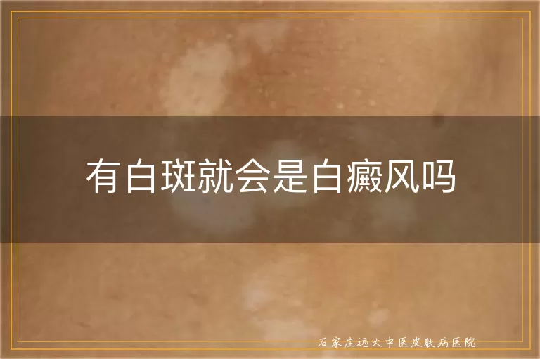 有白斑就会是白癜风吗