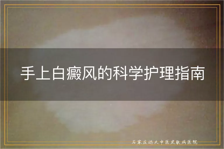 手上白癜风的科学护理指南