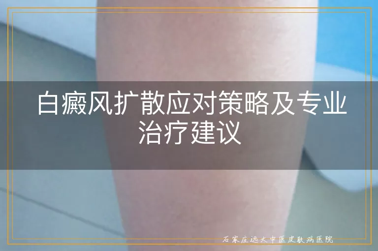 白癜风扩散应对策略及专业治疗建议
