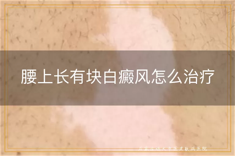 腰上长有块白癜风怎么治疗
