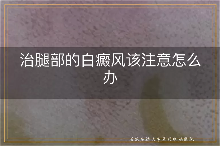 治腿部的白癜风该注意怎么办