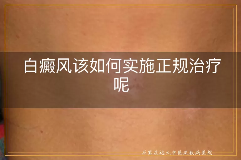 白癜风该如何实施正规治疗呢