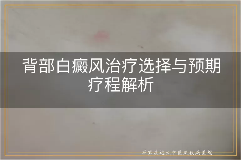 背部白癜风治疗选择与预期疗程解析