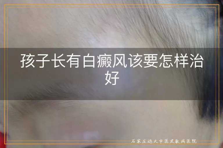 孩子长有白癜风该要怎样治好